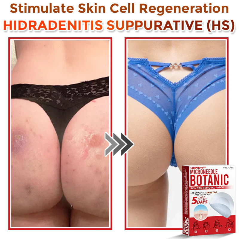 🌈SkinPrikyn™ MicroNeedle Botanic Skin Tag Removal Patch 🇺🇸 Made in the USA