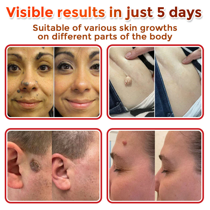 🌈SkinPrikyn™ MicroNeedle Botanic Skin Tag Removal Patch 🇺🇸 Made in the USA