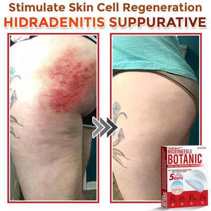 🌈SkinPrikyn™ MicroNeedle Botanic Skin Tag Removal Patch 🇺🇸 Made in the USA